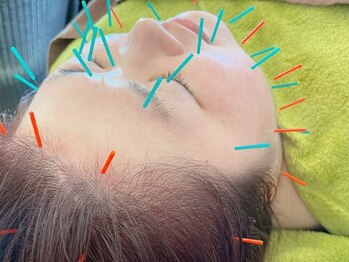 ティーケーエム エンザイム スパ(TKM Enzyme Spa)の写真/あなたの美しさを引き出す美容鍼もご用意!リラックスしながら自分へのご褒美タイムをお楽しみください★