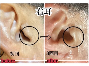 ヴィー(VII)/耳毛脱毛before after