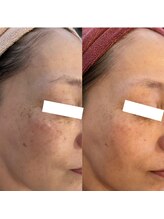 アンク(Ankh)/たった1度のシミケアで激変！