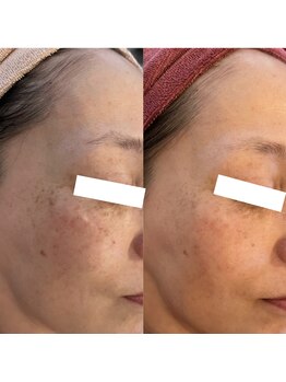 アンク(Ankh)/たった1度のシミケアで激変！