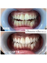 ホワイトニングサロン 京都烏丸店/ホワイトニング施術例