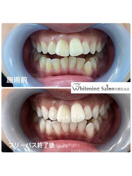 ホワイトニングサロン 京都烏丸店/ホワイトニング施術例