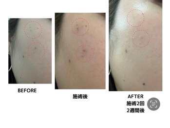 ルアナ 柏店(LUANA)/本格シミケアペンシル