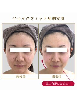 リリーオン 福岡店(RILLEE-ON)/頬のリフトアップ!