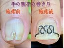 手の親指の破損と巻き爪矯正