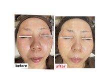 パス アイ(PATH eye)の雰囲気（ダイヤモンドピーリングで角質除去、ポレーションでハリ感アップ）