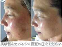 ルノン(LUNON)の雰囲気（シミbefore/afterは、フォトギャラリーをご覧ください♪）