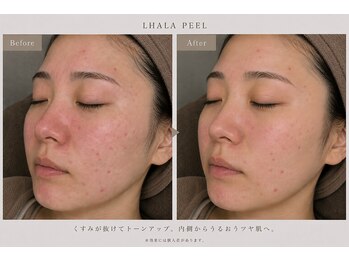 ティースリービューティー(T3Beauty)の写真/【透明感アップ】韓国式肌管理ララピール！ワントーン明るいツルスベ肌へ☆
