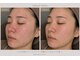 ティースリービューティー(T3Beauty)の写真/【透明感アップ】韓国式肌管理ララピール！ワントーン明るいツルスベ肌へ☆