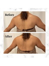 ザビューティー 麻布十番本店(The Beauty)/二の腕リフト打ち放題[リフト]