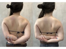 凰湖/ブライダルケア（1回での変化）