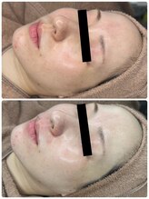 エクラルム(Eclaleum)/BeforeAfter　ララピール