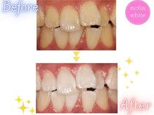 エクシアホワイトニング 明石店/ホワイトニング体験/記念写真