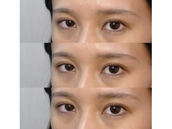 シアミス(SIAMIHS)/メーテルラッシュ