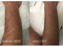 脱毛専門サロン エリクサー(Elixir)/爆抜け！！