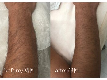脱毛専門サロン エリクサー(Elixir)/爆抜け！！