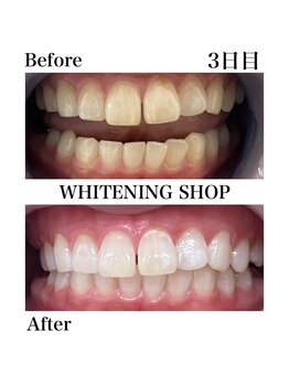 ホワイトニングショップ 豊川店/Before After　3日目のお客様