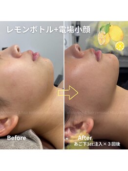 ハピネス 心斎橋アメリカ村本店(Happiness)/レモンボトル