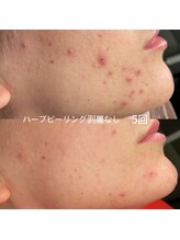 ソアン(Soin)/ハーブピーリング剥離なし