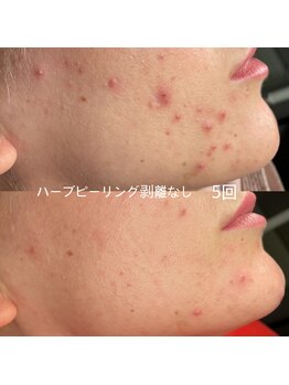 ソアン(Soin)/ハーブピーリング剥離なし