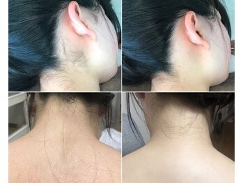 ナチュレアンドメディカ(Nature&Medica)/全身脱毛