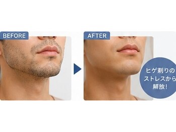 ネオビューティーラボ(NEO beauty labo)の写真/【メンズの剛毛・ヒゲ・VIO悩みに】
清潔感のあるツルスベ肌へ