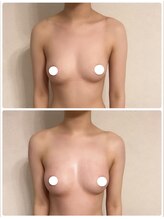 プリマ(prima)/バストアップ症例