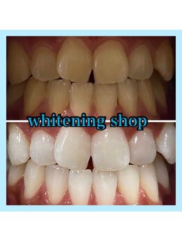 ホワイトニングショップ 天王寺店/10回ご来店後のお写真です