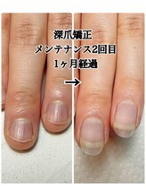 スマイルニコ(smile nico)/深爪矯正はメンテナンスできます