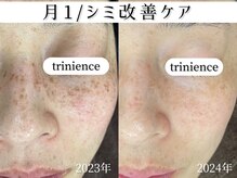 トリニエンス 新宿店(TRINIENCE)/30代/シミケア/肌代謝ケア