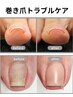 巻き爪トラブル改善
