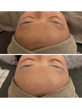 ネオファースト 大阪福島店(NeoFirst)/つるすべ肌に#ワックス脱毛