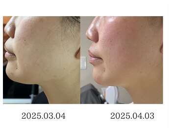 オウカ(OUKA)/レモンボトルで小顔に！