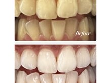 【羽村】セルフホワイトニング専門驚きの白さを体験してください