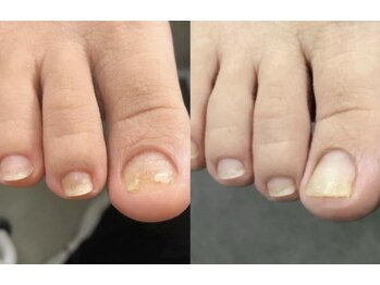 ティアラネイル 宇都宮/深爪矯正