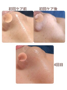 エミナル バイ ニコドット(Eminal by nico.)/なくならない毛穴詰まり（40代）