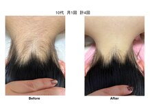 キュラフィン(Curafin)/女性うなじ症例写真