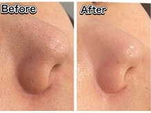 クリニカルホワイトケア(クリニカルWHITEケア)/毛穴洗浄