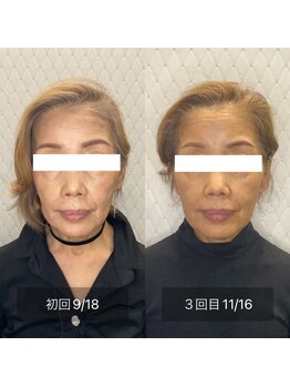 カドル 福岡天神店(KADORU)/小顔矯正+美容機器 Before-Aftet