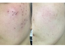 チャンス(CHANCE)の雰囲気(≪シミケア≫施術後から一週間前後に垢がとれて変化を実感♪)