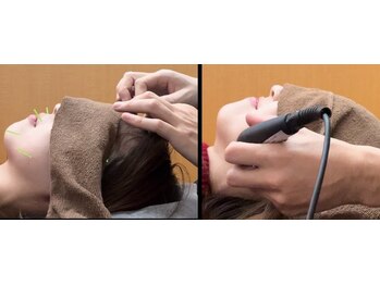 ながっち鍼灸治療院/電気と美容鍼をセットで♪