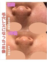 パルティノ 高崎店/毛穴洗浄