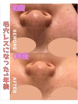 パルティノ 高崎店/毛穴洗浄