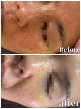 アズ(AZU)/●Before after