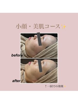 エステティック レイビス 新宿店(RAYVIS)/小顔と美肌の両方を叶える☆