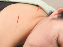 ハーモニープラス/鍼灸施術1