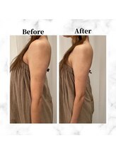 ザビューティー 麻布十番本店(The Beauty)/二の腕リフト打ち放題[リフト]