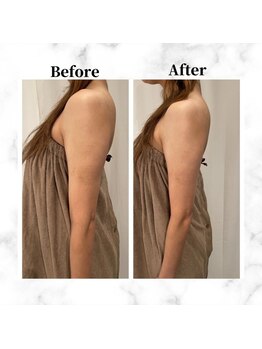 ザビューティー 麻布十番本店(The Beauty)/二の腕リフト打ち放題[リフト]