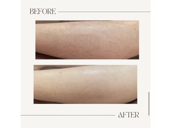 カッツエステティックサロン 東尾道/【before after】