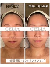 セリア(CELIA)/小顔矯正